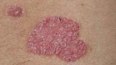 داء الصدف "الصدفية – Psoriasis"