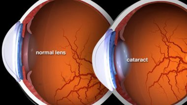 اكتشاف طريقة جديدة لعلاج إعتام عدسة العين
