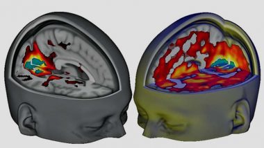  تأثير LSD على مخ الإنسان